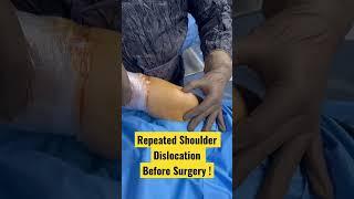 REPEATED SHOULDER DISLOCATION #sportsinjury #arthroscopy #keyholesurgery #shoulder #pain