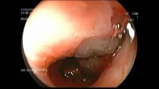 Managing Live Leech and Roundworm Endobronchial Infestation