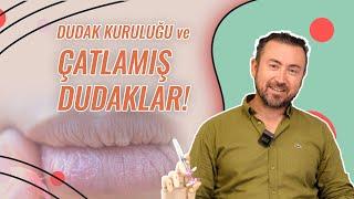 Dudak Kuruluğu, Çatlamış Dudaklar: Dermatolog Önerileri  Dry,Chapped Lips: Dermatologist Suggestions