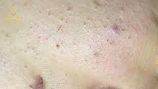Loan Nguyen Acne Treatment 345pre