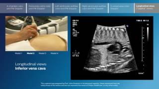 Advanced screening views of the fetal heart - Part 6 - Longitudinal views