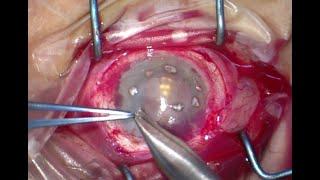 Simple Limbal Epithelial Stem Cell Transplantation "SLET" for Corneal Stem Cell Failure