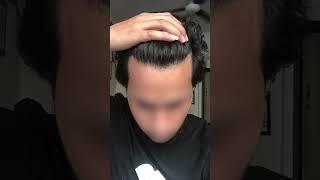 Transforming Hair, Transforming Lives! Witness the amazing results of our hair transplant procedure