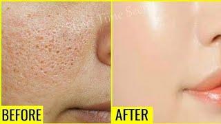 How to remove open pores|beauty secret by samira