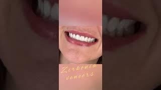 Gold Veneers - Dr. Serhan Aktan