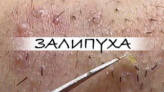 ПРЫЩИ  ПРЫЩИ ВЫДАВЛИВАНИЕ  ПОДБОРКА ВЫДАВЛИВАНИЕ ПРЫЩЕЙ #прыщи #acne #asmr #прыщиналице