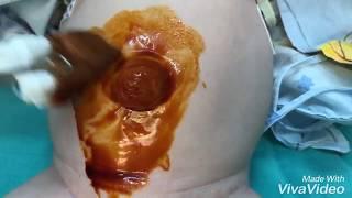 umbilical hernia child. Qiqant Gobek yirtigi