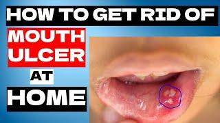 5 Amazing Home Remedies to Get Rid of A Mouth Ulcer Fast | Mouth Ulcer Treatment At Home