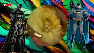 Earwax | giant earwax 100.5