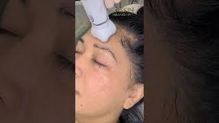 New Tech FibroLift Collagen Boost: Non-Invasive No Marks No Downtime www.RejuvadermFacial.com