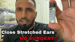Close Stretched Ears Without Surgery!! (Must Watch!)
