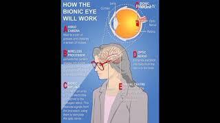 The #bionic #eye #system #and #how #it #functions #PART #2