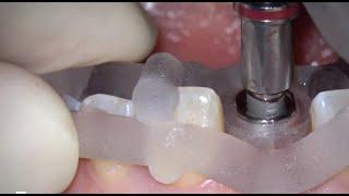Dr. Ventseslav Stankov: Immediate Implant in a Perfect Socket