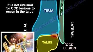 Osteochondral Lesions Of The Talus - Everything You Need To Know - Dr. Nabil Ebraheim