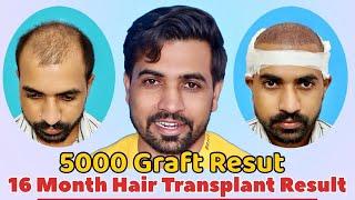 Hair Transplant Result in India | Average Cost Hair Transplant Result |  Diet Care