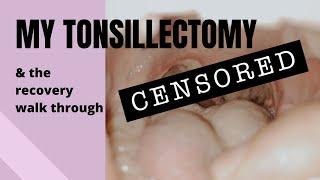 MY TONSILLECTOMY (Day-by-day recovery walkthrough)