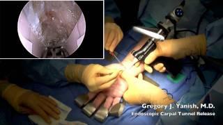 Endoscopic Carpal Tunnel Release