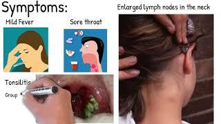 Infectious mononucleosis  - Easy explained