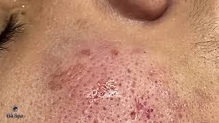 Squeeze Perennial Blackheads