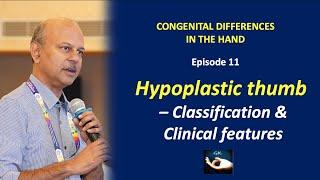 Congenital hand: Episode 11 - Hypoplastic Thumb - Classification and Clinical features