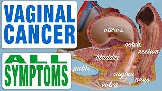 Vaginal Cancer - All Symptoms