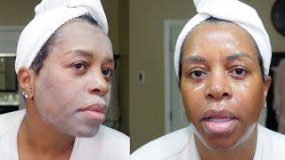 Doing my own chemical peel at home for the First Time - OMG What happened | LISETTE JANAE