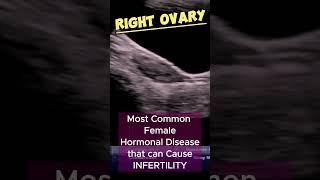 PCOS - Polycystic Ovaries | PCO - TVS Ultrasound