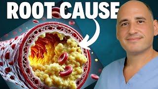 Heart Surgeon’s TRUTH about Carnivore Diet & Cholesterol