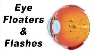 Eye Floaters: What Are They & What Causes Them?