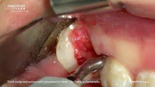 PIEZOSURGERY - Dr. Fabrizio Fontanella - Third Molar Extraction with piezoelectric levers