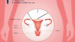 Animation of Total Laparoscopic Hysterectomy