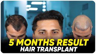 Hair Transplant in India | Best Results & Cost of Hair Transplant in India