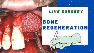 BONE REGENERATION surgery - Bone grafting technique live.