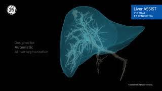 GE Healthcare Liver assist virtual parenchyma - A