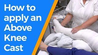 How to apply an Above Knee Cast