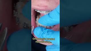 Orthodontic bracket repositioning - Tooth Time Family Dentistry New Braunfels