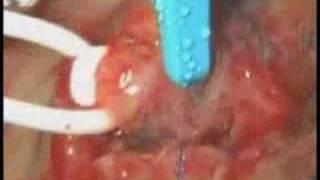 Anastomosis (CABG) procedure featuring Cardica's C-Port xA