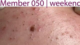 Acne Treatment Huong Da Nang# 050 | weekend | 2023