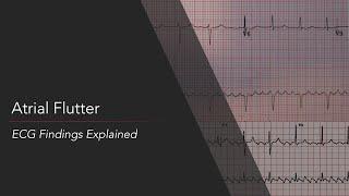 Atrial Flutter: ECG Findings Explained