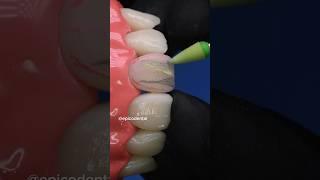 Composite veneers. Direct composite restoration front teeth. Veneers #dentist #dentalstudent