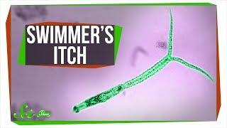 The Horrifying Truth About Swimmer's Itch