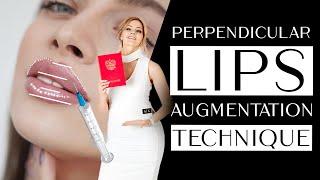 Perpendicular lip augmentation technique video lesson