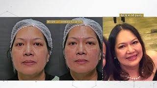 Collagen filler for eyebag and skin laxity | Dr. Contessa Salvador