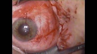 DOUBLE LAYER AMT FOR CONJUNCTIVAL RECONSTRUCTION AFTER RECURRENT SQUAMOUS CELL CARCINOMA