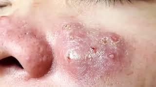 Blackheads & Milia, Big cystic acne blackheads extraction whiteheads Removal Pimple Popping  7