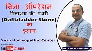 पित्ताशय की पथरी (Gallbladder Stone) का बिना ऑपरेशन के इलाज | Yash Homeopathic Center