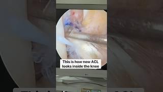 Watch New ACL hold strong #acltear #aclinjury #kneearthroscopy