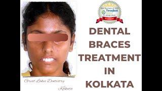 Dental Braces Procedure | Best Dental Braces Clinic in Kolkata | Orthodontic Treatment in Kolkata