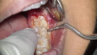 Wisdom Tooth Extraction Without Forceps (E.W.F.) | Dr. Fabio Cozzolino, Zerodonto