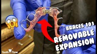 Dental Braces Removable Expansion - Toothtime New Braunfels